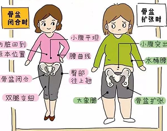 盆骨修复 容易造成小腹突出,水桶腰,大象腿,骨盆扩张